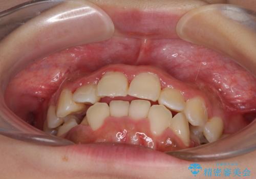 前後に重なった前歯 ワイヤー装置と急速拡大装置を併用したインビザライン矯正の治療中