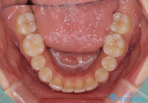 前歯2本が欠損　抜歯矯正でデコボコを治すの治療後