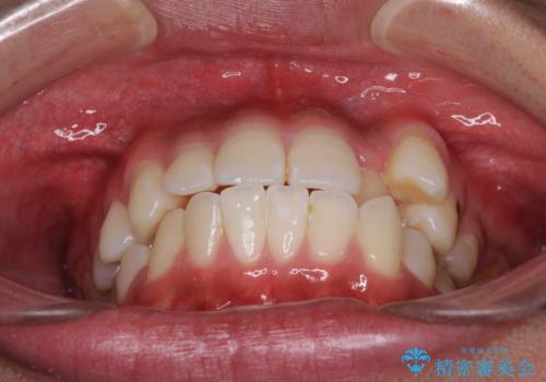 八重歯と奥歯のクロスバイト 上顎骨を拡大してインビザラインで矯正の治療前
