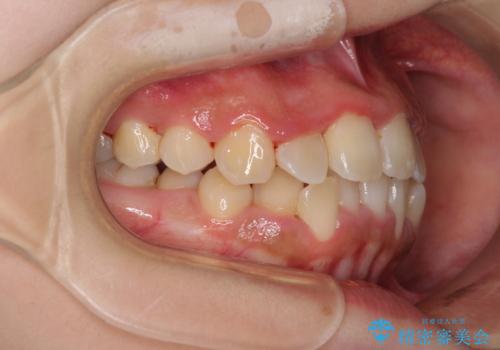 前後に重なった前歯 ワイヤー装置と急速拡大装置を併用したインビザライン矯正の治療中