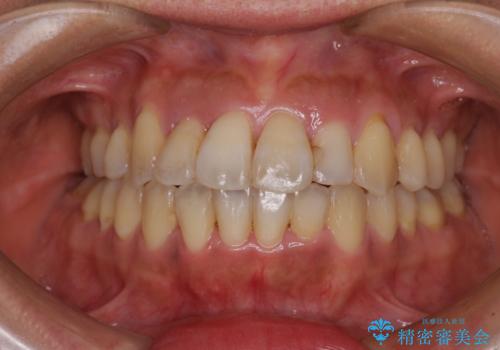 狭い上顎骨を拡大 著しい叢生を抜歯矯正で改善