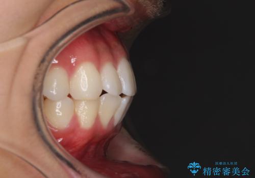 八重歯と奥歯のクロスバイト 上顎骨を拡大してインビザラインで矯正の治療前