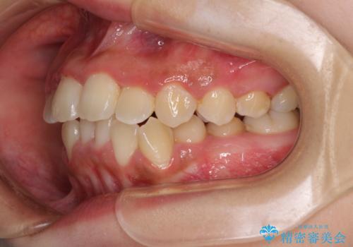 前後に重なった前歯 ワイヤー装置と急速拡大装置を併用したインビザライン矯正の治療中