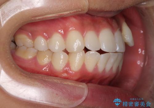 八重歯と奥歯のクロスバイト 上顎骨を拡大してインビザラインで矯正の治療前