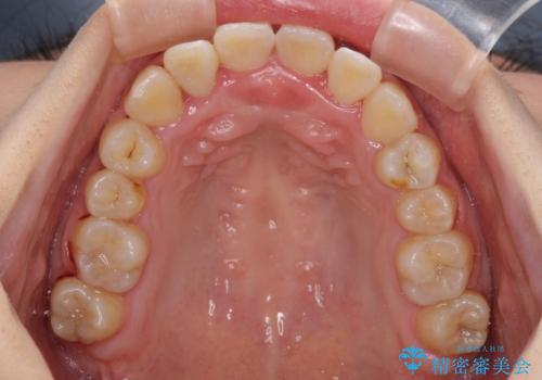 前後に重なった前歯 ワイヤー装置と急速拡大装置を併用したインビザライン矯正の治療中