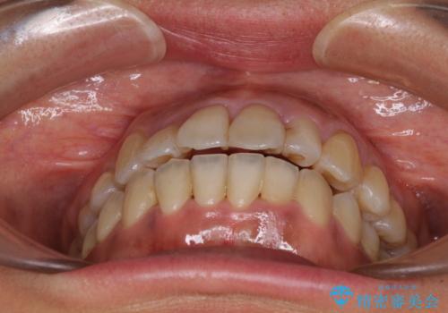 狭い上顎骨を拡大 著しい叢生を抜歯矯正で改善の治療後