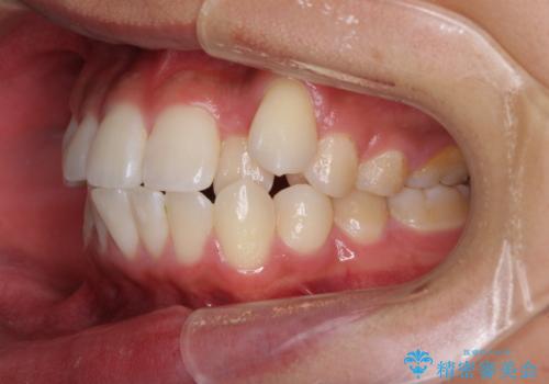 八重歯と奥歯のクロスバイト　上顎骨を拡大してインビザラインで矯正の治療前