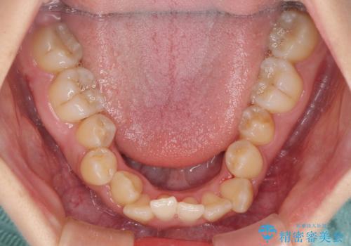 前後に重なった前歯 ワイヤー装置と急速拡大装置を併用したインビザライン矯正の治療中