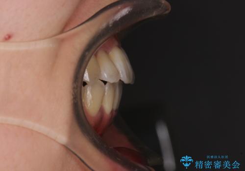 狭い上顎骨を拡大 著しい叢生を抜歯矯正で改善の治療後