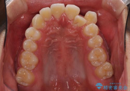 八重歯と奥歯のクロスバイト 上顎骨を拡大してインビザラインで矯正の治療前
