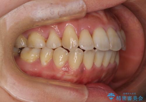 狭い上顎骨を拡大　著しい叢生を抜歯矯正で改善の治療後