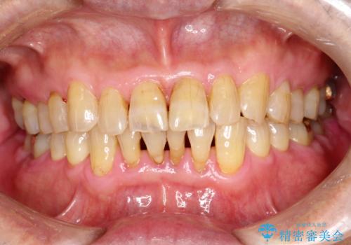 2カ月おきにメンテナンスの治療後