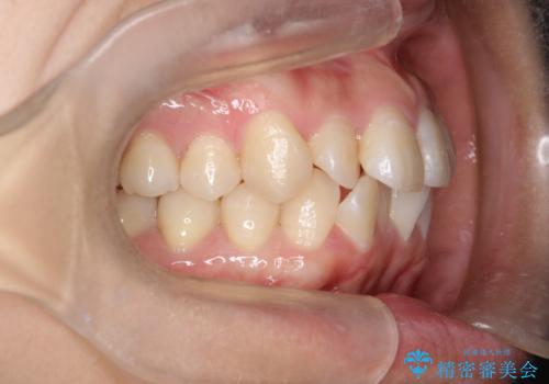 【インビザライン】前歯の凸凹をなおしたいの治療前
