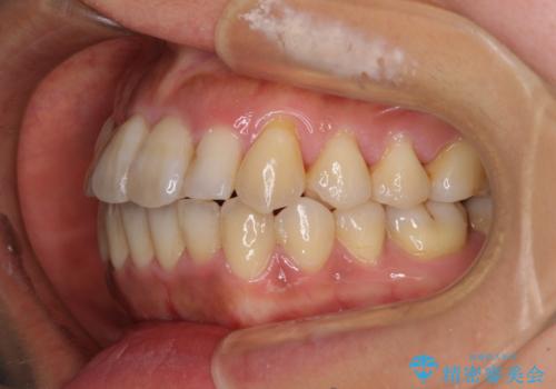 狭い上顎骨を拡大　著しい叢生を抜歯矯正で改善の治療後