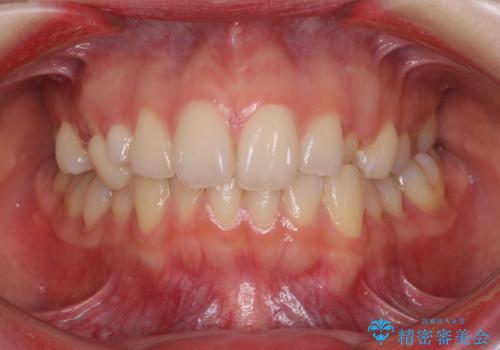 狭い上顎骨を拡大 急速拡大装置を併用したインビザライン矯正の症例 治療前