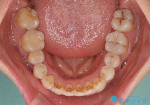 狭い上顎骨を拡大 著しい叢生を抜歯矯正で改善の治療後