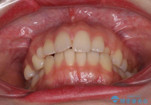 狭い上顎骨を拡大 急速拡大装置を併用したインビザライン矯正の治療前