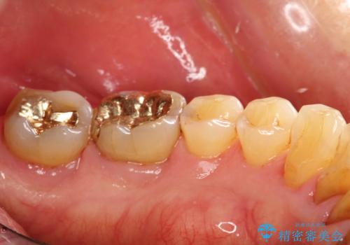 2カ月おきにメンテナンスの治療後