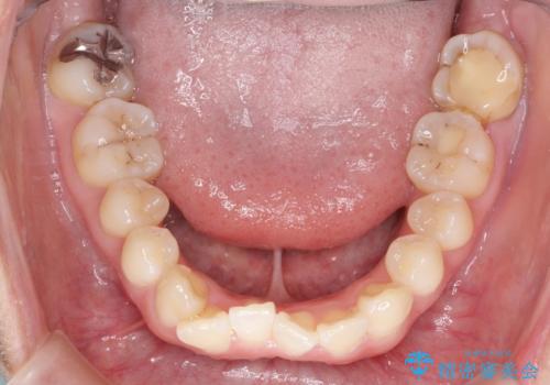 【インビザライン】前歯の凸凹をなおしたいの治療前