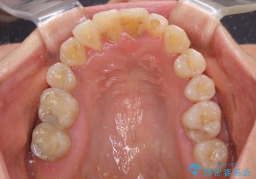 狭い上顎骨を拡大 著しい叢生を抜歯矯正で改善の治療後