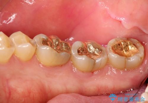 2カ月おきにメンテナンスの治療後