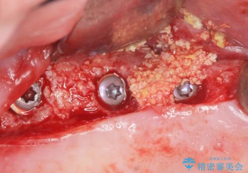 歯がぐらぐら 上顎洞底挙上術を併用した奥歯のインプラント 50代男性の治療中