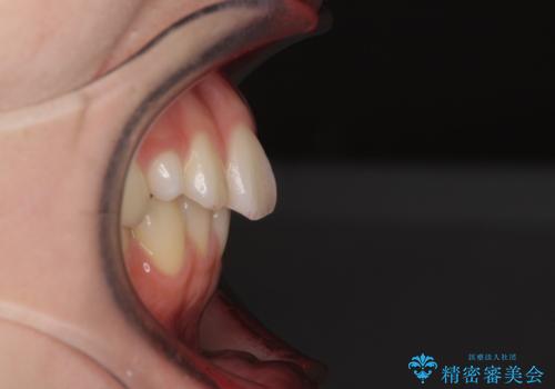 狭い上顎骨を拡大 急速拡大装置を併用したインビザライン矯正の治療前