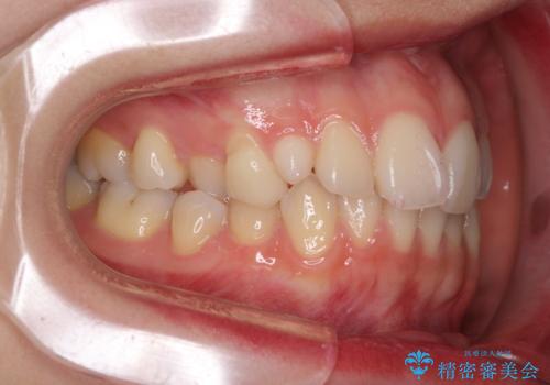 狭い上顎骨を拡大 急速拡大装置を併用したインビザライン矯正の治療前