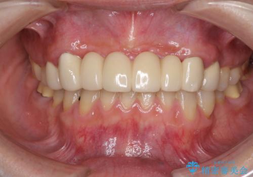 出血が止まらない インプラント補綴を用いた歯周病治療の症例 治療前