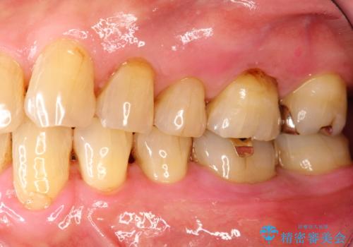 2カ月おきにメンテナンスの治療後