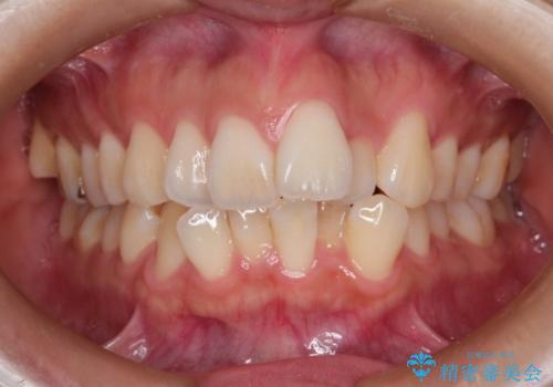 スッキリとした口元へ　出っ歯の抜歯矯正の症例 治療前