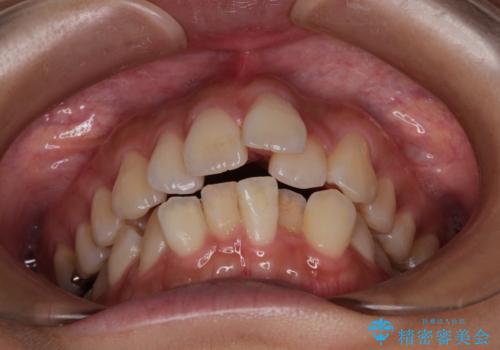 スッキリとした口元へ　出っ歯の抜歯矯正の治療前