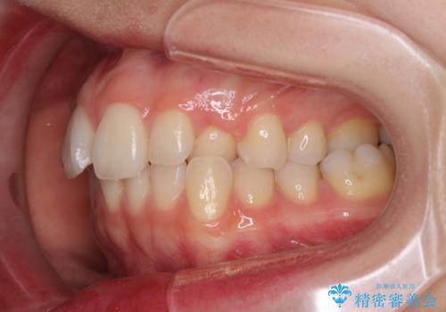 狭い上顎骨を拡大 急速拡大装置を併用したインビザライン矯正の治療前