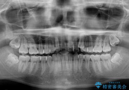 八重歯と奥歯のクロスバイト 上顎骨を拡大してインビザラインで矯正の治療前