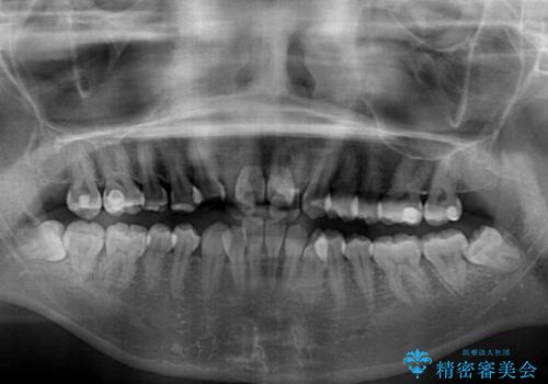 前後に重なった前歯 ワイヤー装置と急速拡大装置を併用したインビザライン矯正の治療前