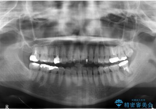歯が割れた 親知らずの移植 30代女性の治療前