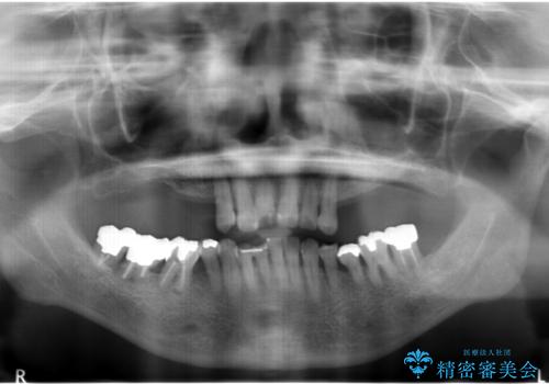 奥歯がないまま過ごしていたら前歯もぐらぐらしてきた　60代女性の治療前