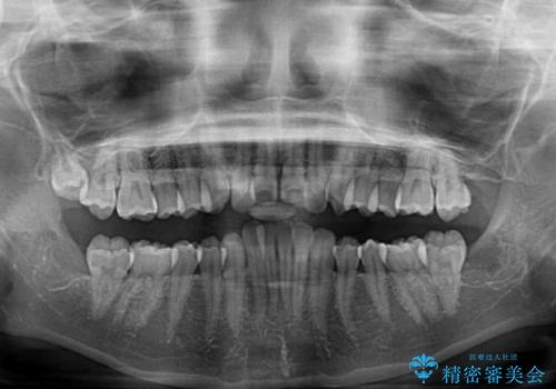 費用を抑えた抜歯矯正　口元の突出感の改善の治療前