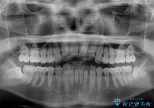 気になる前歯のデコボコをインビザラインで解消の治療前