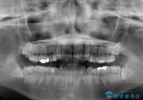 八重歯の抜歯矯正 補助装置を用いたインビザライン矯正の治療前