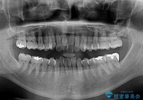 前歯のデコボコ ワイヤー装置での短期間治療の治療前