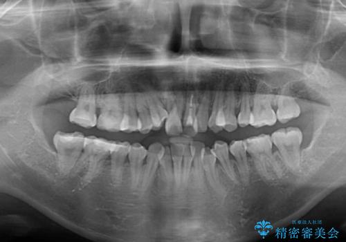 狭い上顎骨を拡大 著しい叢生を抜歯矯正で改善の治療前
