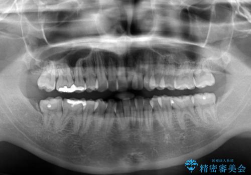 スッキリとした口元へ 出っ歯の抜歯矯正の治療前