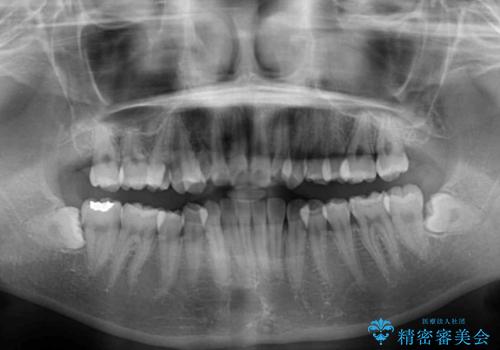 狭い上顎骨を拡大 急速拡大装置を併用したインビザライン矯正の治療前