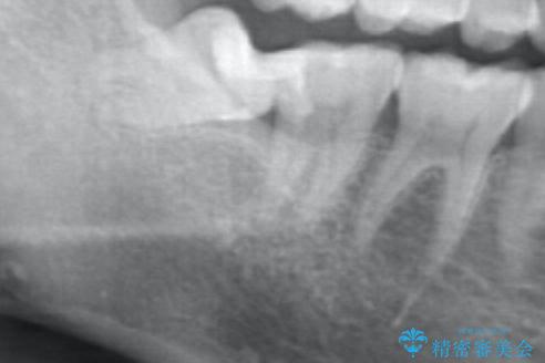親知らずを起因とする虫歯治療