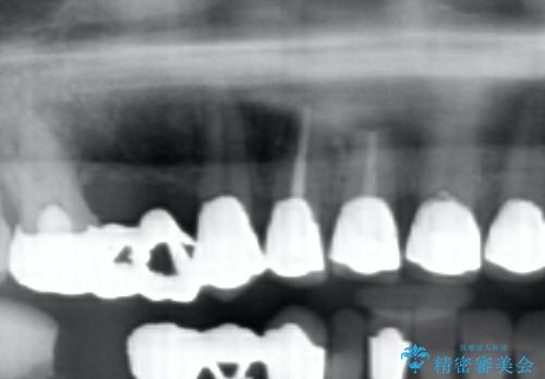 状況に応じた前歯の補綴計画の治療前