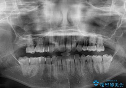 費用を抑えた抜歯矯正　口元の突出感の改善の治療後