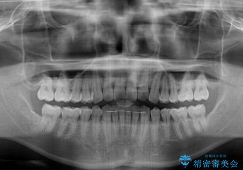 気になる前歯のデコボコをインビザラインで解消の治療後