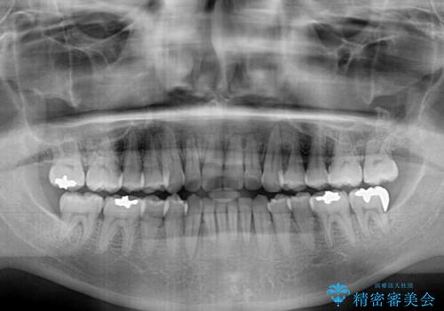 前歯のデコボコ ワイヤー装置での短期間治療の治療後