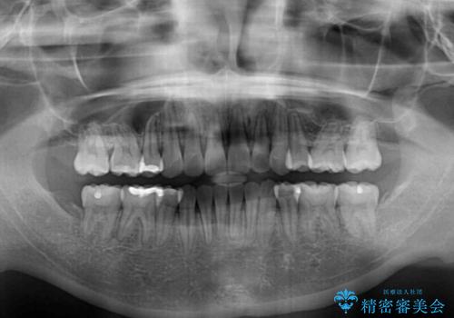スッキリとした口元へ 出っ歯の抜歯矯正の治療後